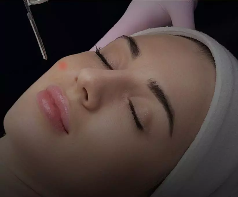 Beard Laser Hair Removal
